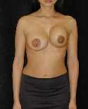 Breast Implant Revision Surgery