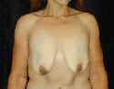 Breast Lift Surgery