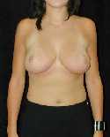 Breast Reduction Surgery