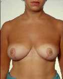 Breast Reduction Surgery