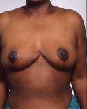 Breast Reduction Surgery