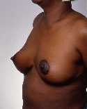 Breast Reduction Surgery