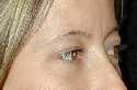 Eyelid (Blepharoplasty) Surgery
