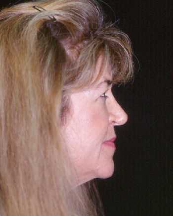 Facelift and Necklift