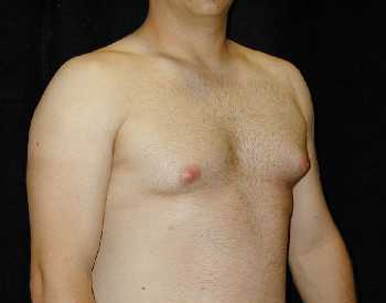 Gynecomastia (Male Breast) Surgery